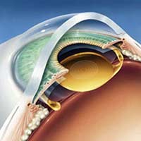 Lens Implant After Cataract Surgery